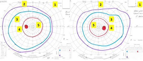 abnormal visual field test results